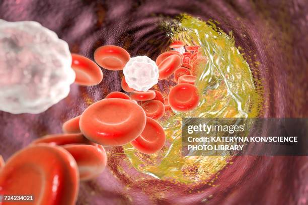 stockillustraties, clipart, cartoons en iconen met atheromatous plaque destruction, illustration - cholesterol