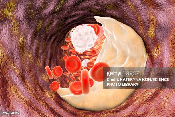 atheromatous plaque, illustration - ldl cholesterol stock illustrations