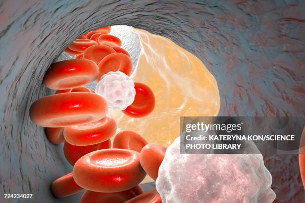 illustrazioni stock, clip art, cartoni animati e icone di tendenza di atheromatous plaque, illustration - lipoproteina a bassa densità