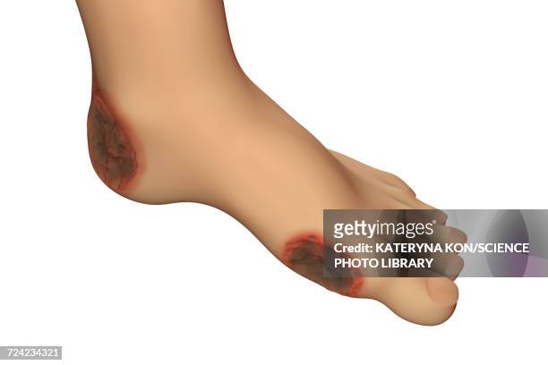 diabetic foot ulcers, illustration - infected wound stock-grafiken, -clipart, -cartoons und -symbole