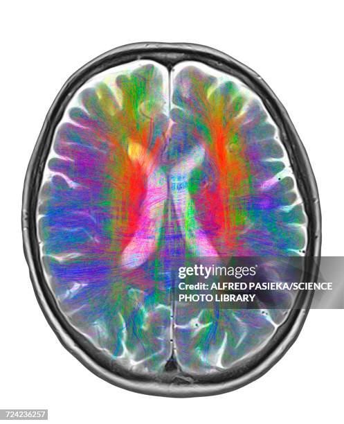 Mri Pathways Neurological Pathways Photos and Premium High Res Pictures - Getty Images
