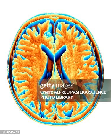 MRI Brain scan, heightmap MRI Brain scan, heightmap