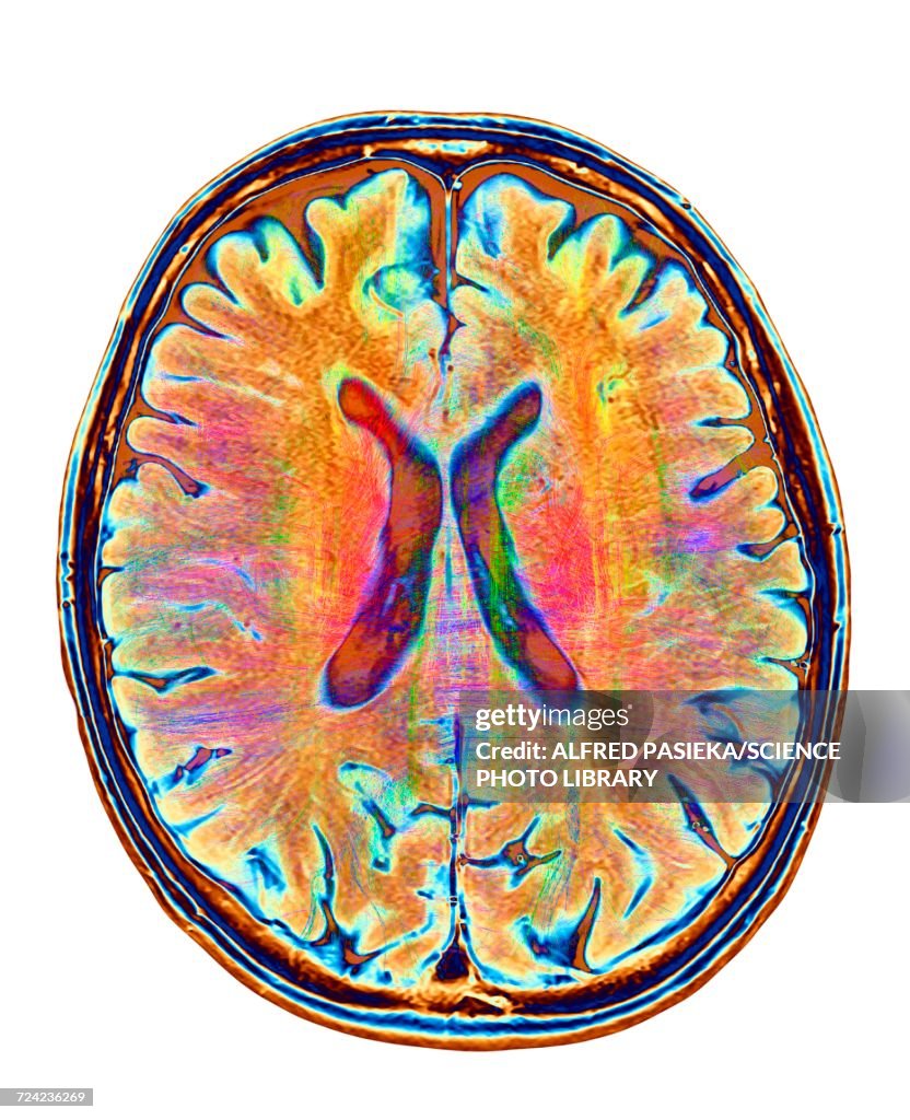 Brain MRI and white matter fibres