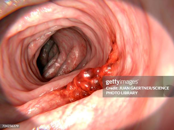 ilustraciones, imágenes clip art, dibujos animados e iconos de stock de colon cancer, illustration - endoscopio