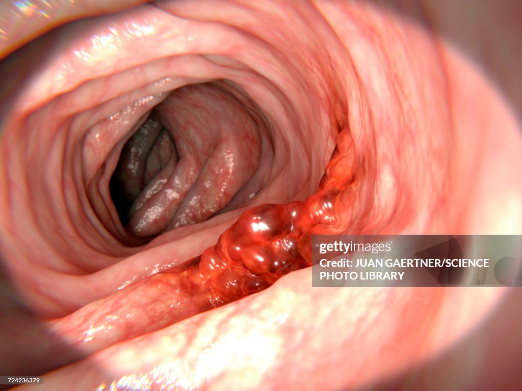 Colon cancer, illustration