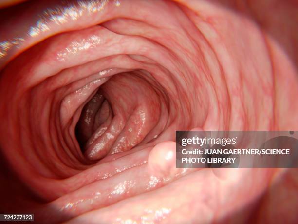 intestinal polyps, illustration - polyp stock illustrations