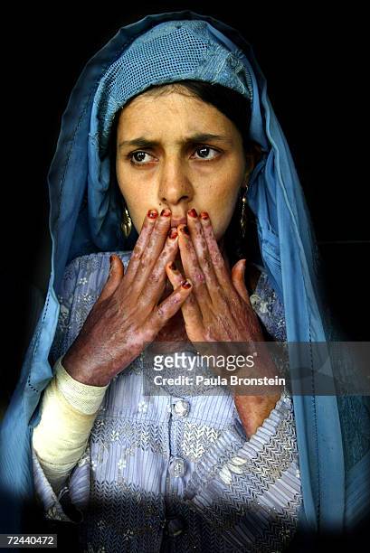 Masooma, 18-years-old, who suffers with severe burns on 70% of her body from self-immolation, shows her scars on her hands at the Herat Regional...