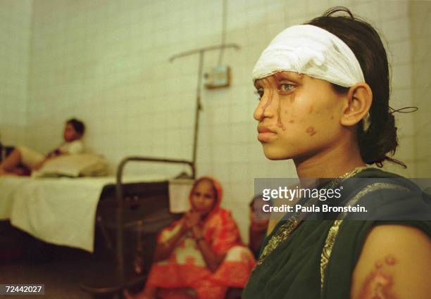 Asma, a Bangladeshi woman suffering burns from a battery acid attack, sits in a hospital July 2000 in Dhaka, Bangladesh. Asma is eight months...