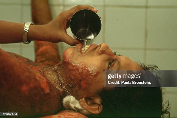 Reba, a 19 year-old Bangladeshi woman, lies in extreme pain July 2000 in Dhaka, Bangladesh, suffering from wounds from a battery acid attack. Reba...