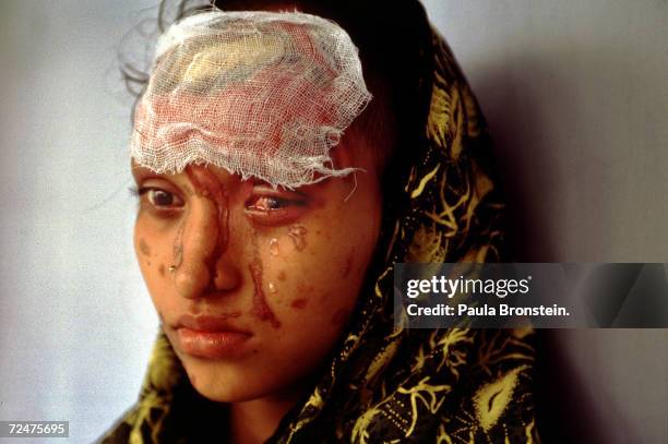 Tears run uncontrollably from Asma's eyes July 2000 in Dhaka, Bangladesh because of severe damage from a battery acid attack by her boyfriend two...