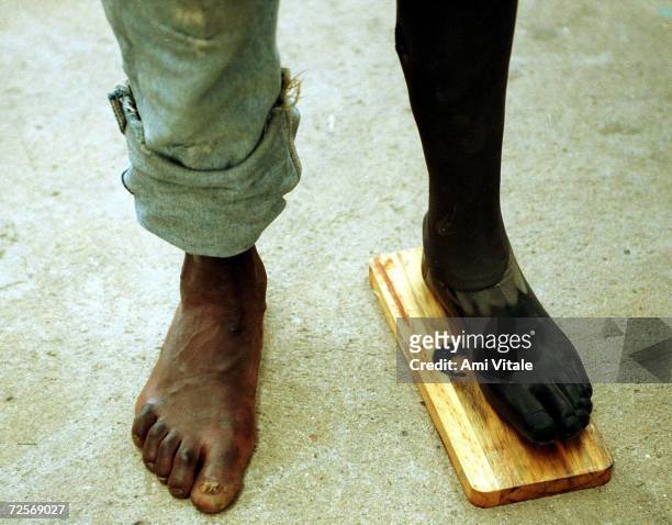 An Angolan waits to see a doctor at the International Red Cross hospital in Huambo, Angola March 5, 2000. More than 650,000 Angolans have been killed...