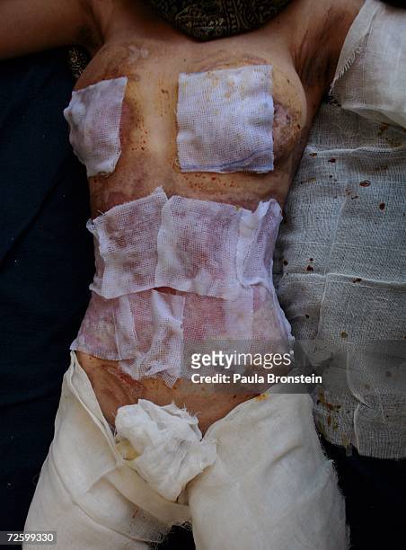 The burned body of Simagul a self immolation victim, lays on a bed at the Herat hospital November 16, 2006 in Herat, Afghanistan. Simagul complained...