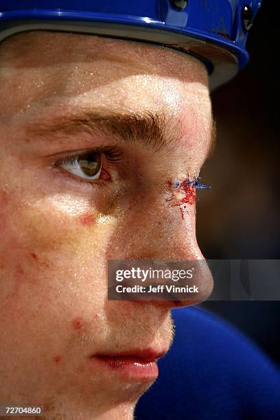 Rick Rypien of the Vancouver Canucks sports fresh stitches in his nose as a result of his fight with Ian Laperriere of the Colorado Avalanche during...