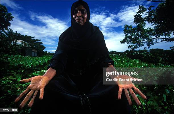 Local women displays her hands which have the symptoms of Arsenic poisoning. Many thousands of wells have been constructed in Bangladesh by...
