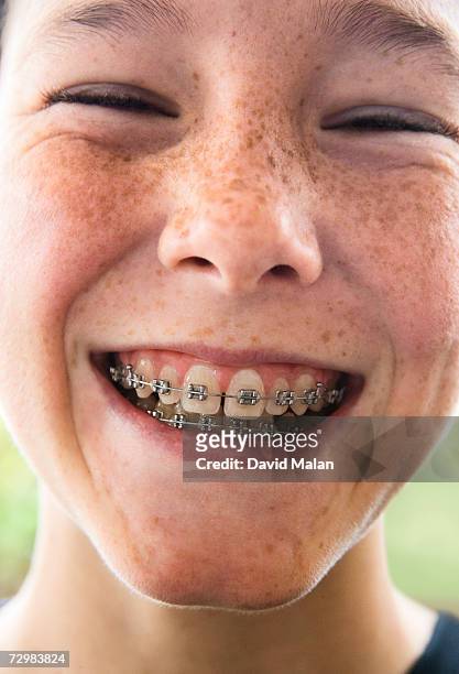 portrait of girl in braces smiling, close up, close-up, portrait - orthodontics stockfoto's en -beelden
