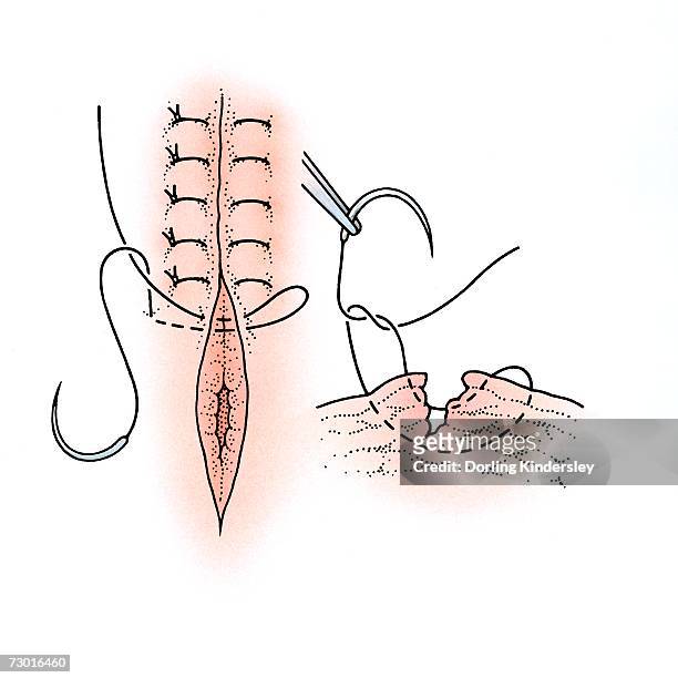 ilustraciones, imágenes clip art, dibujos animados e iconos de stock de diagram showing surgical repair of a torn vagina. - sutura