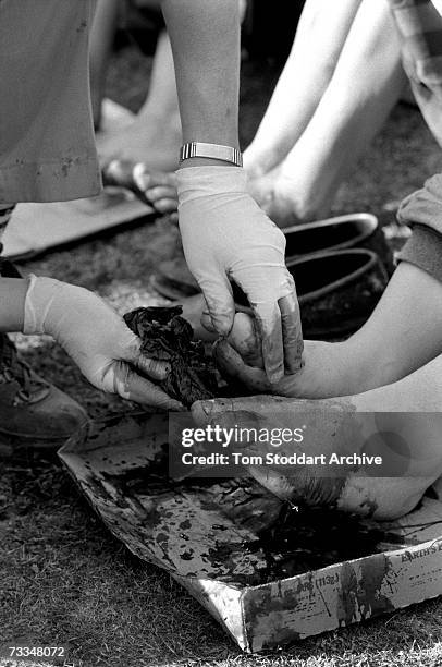 Doctor attends to the blistered feet of a new arrival at the refugee camp in Kukes, Albania, which became home to thousands of people fleeing from...