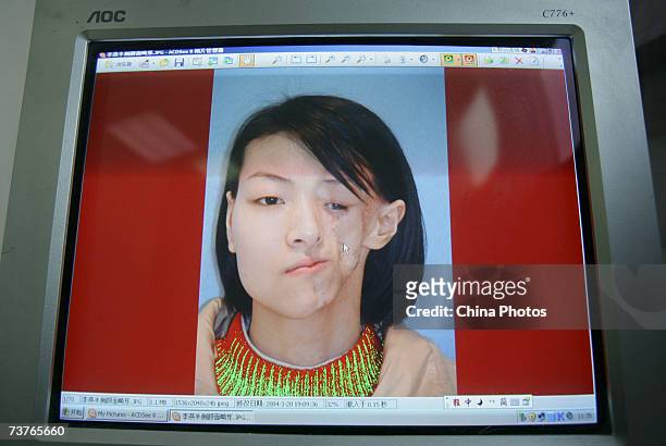 Chinese girl Li Yan, who suffers from face atrophy, is seen on a monitor before her corrective surgery on April 2, 2007 in Chongqing Municipality,...