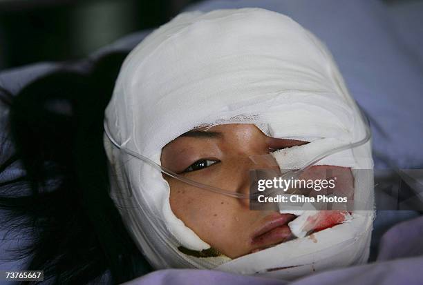 Chinese girl Li Yan, who suffers from face atrophy, lies on a bed after her second corrective surgery, at a hospital on April 2, 2007 in Chongqing...
