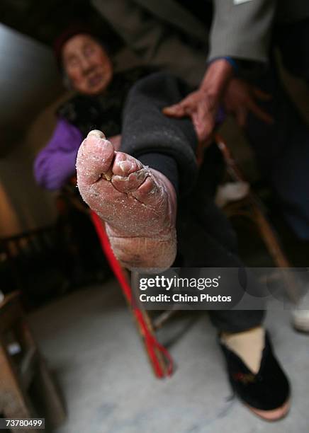 Year-old bound feet woman, whose surname is Luo Pu, displays her bound foot in her home, at Liuyi Village on April 3, 2007 in Tonghai County of...