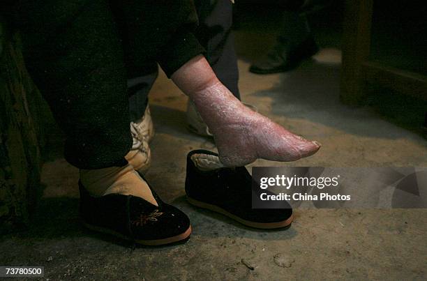 Year-old bound feet woman, whose surname is Luo Pu, displays her bound foot in her home, at Liuyi Village on April 3, 2007 in Tonghai County of...