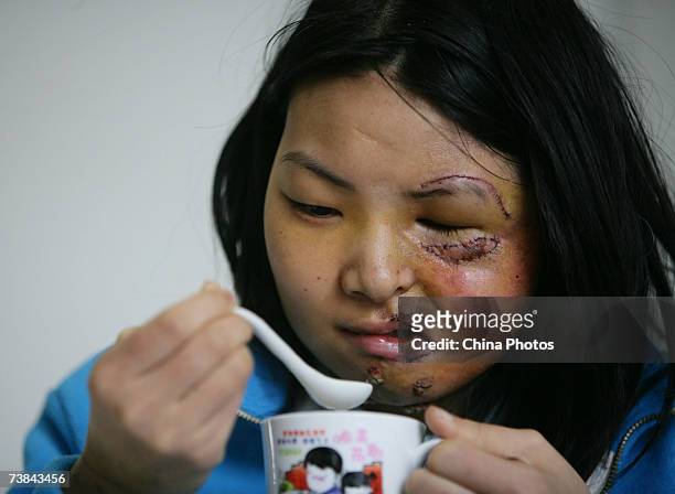 Chinese girl Li Yan, who suffers from face atrophy, drinks water before doctors remove stitches from the wound, at Chongqing Emergency Medical Center...