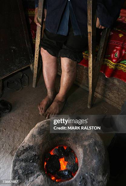 By Benjamin Morgan Farmer Zhang Huaixiang - 57, stands next to a coal fire as he shows his bowed legs which were caused by fluorosis poisoning at his...