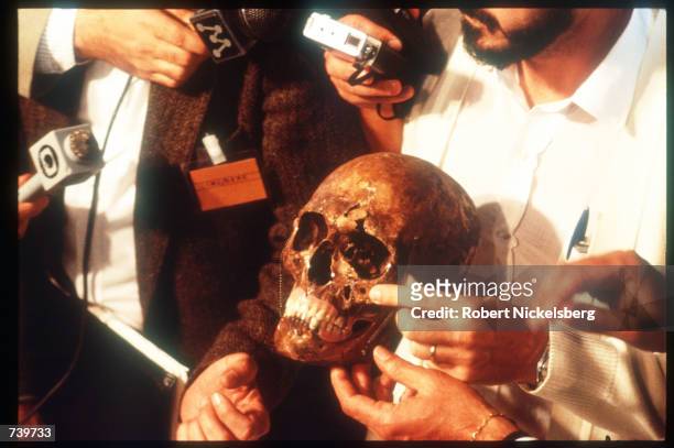 The purported skull of Josef Mengele is on display for reporters and news crews June 6, 1985 in Embu, Brazil. It is believed that notorious Nazi...