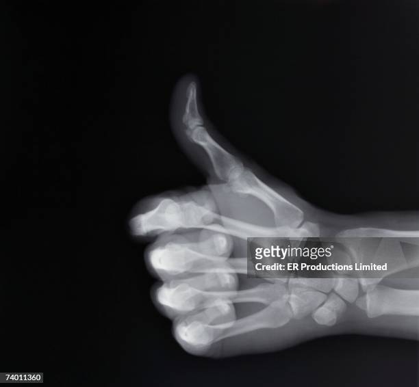 x-ray of hand making thumbs up gesture - röntgen stock-fotos und bilder