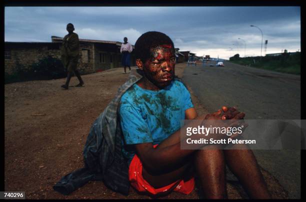 An unidentified man displays manchete wounds by civilians who thought he was a militiaman May 26, 1994 in Kigali, Rwanda. Refugees flee the genocide...
