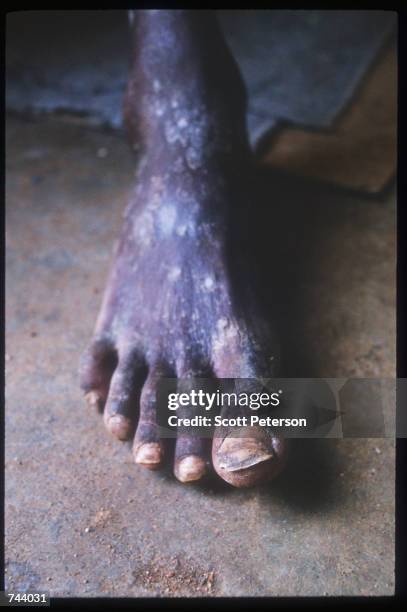 Foot ravaged by skin ailments December 15, 1992 in Baidoa, Somalia. Somalia fell into anarchy after the fall of Siad Barre's twenty-two year rule and...