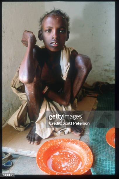 Ibrahim Ali Mohammed recovers on a diet of gruel and biscuits December 15, 1992 in Baidoa, Somalia. Somalia fell into anarchy after the fall of Siad...