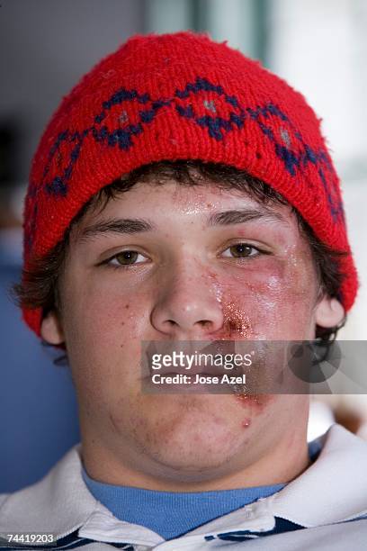 an injured teenager. - ugly boys fotos stock-fotos und bilder