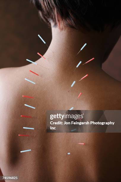 acupuncture needles in african woman's back - acupuncture stockfoto's en -beelden