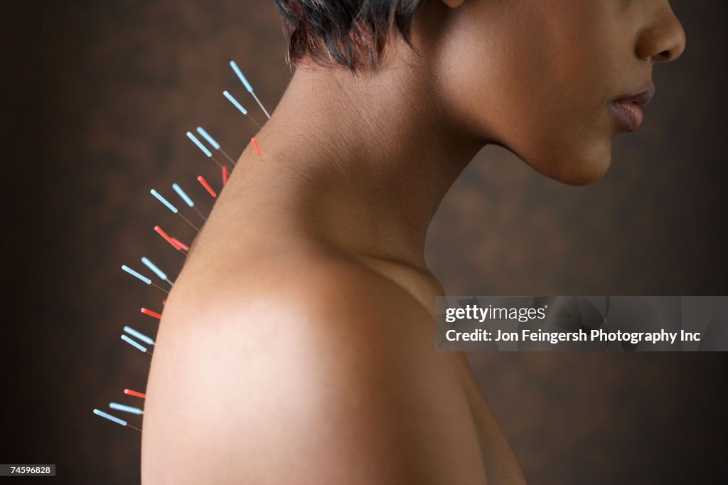 Acupuncture needles in African woman's back