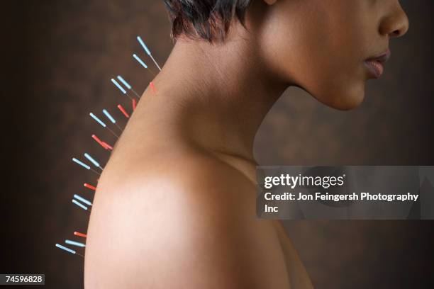 acupuncture needles in african woman's back - accupuncture 個照片及圖片檔