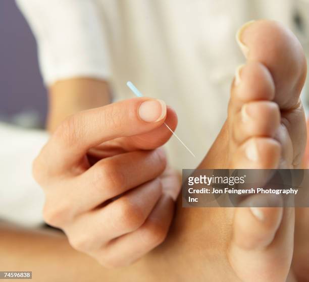 close up of acupuncture treatment - pointed foot stock pictures, royalty-free photos & images