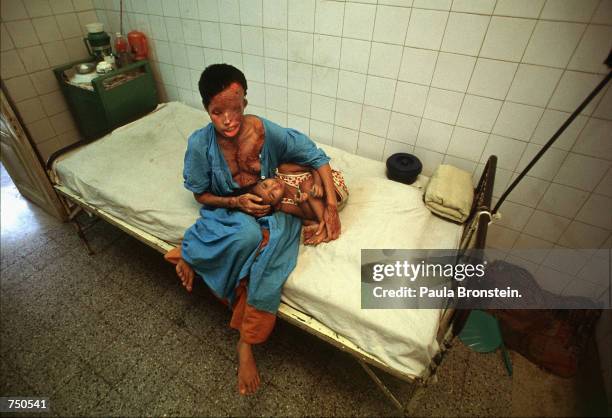 Popi, a 22 year-old Bangladeshi woman who suffered severe burns from a battery acid attack, sits with her son, Akhi, age 2, in a hospital July 2000...