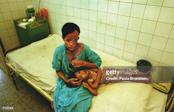 Popi, a 22 year-old Bangladeshi woman who suffered severe burns from a battery acid attack, sits with her son Akhi, age 2, in a hospital July 2000 in...