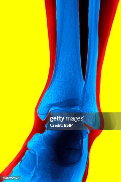 ankle,x-ray - astragalus stock-fotos und bilder