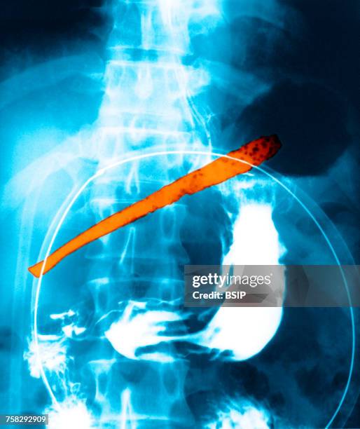 foreign body in stomach - abscess - fotografias e filmes do acervo