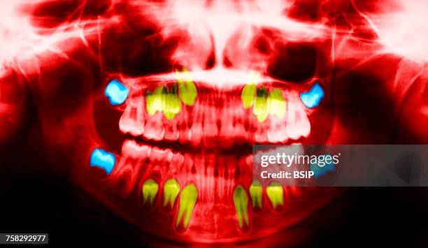 child tooth,x-ray - wisdom teeth stock pictures, royalty-free photos & images