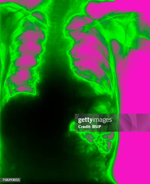 diaphragmatic hernia,x-ray - diaphragmatic hernia stock pictures, royalty-free photos & images