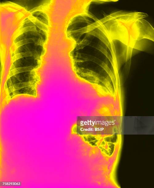 diaphragmatic hernia,x-ray - diaphragmatic hernia stock pictures, royalty-free photos & images