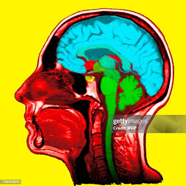 head,mri - middenhersenen stockfoto's en -beelden