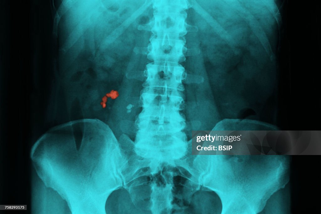 Renal lithiasis,x-ray