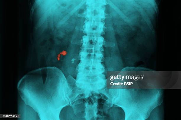 Lithiasis Kidney Stone Xray Photos and Premium High Res Pictures - Getty Images