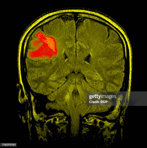 nmr cerebral lymphoma - lymphoma 個照片及圖片檔