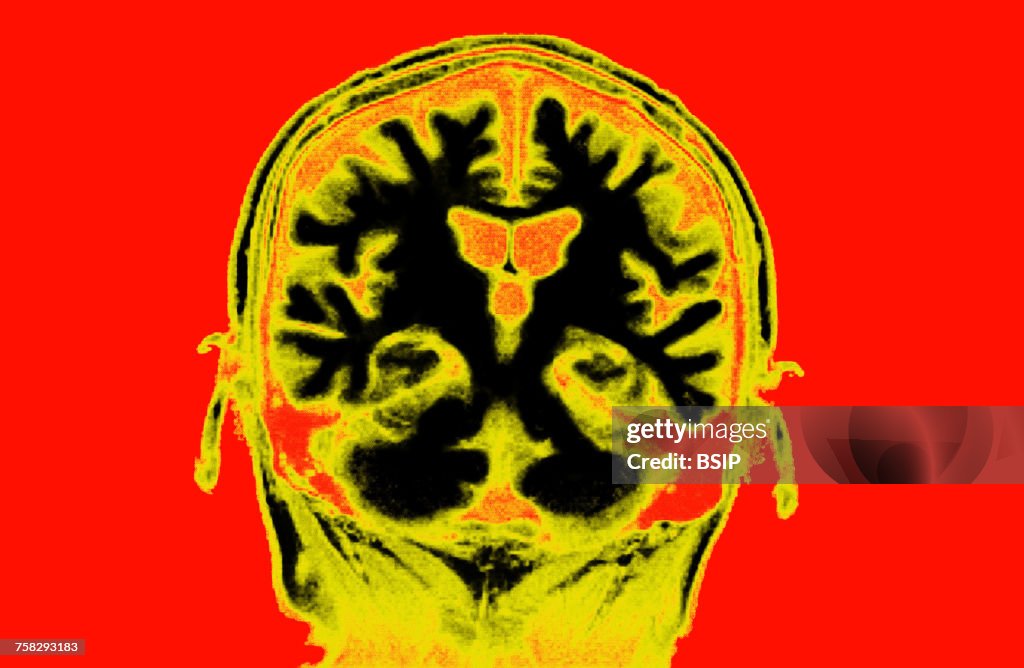 Brain,mri