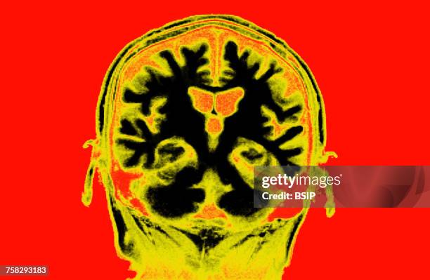 brain,mri - amygdala stock pictures, royalty-free photos & images